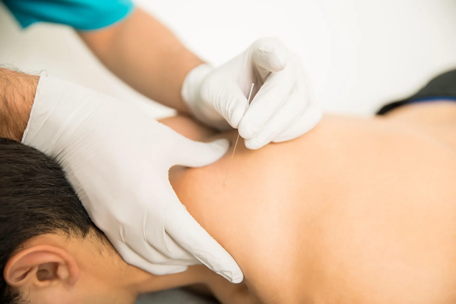 Triggerpunkttherapie und Dry Needling